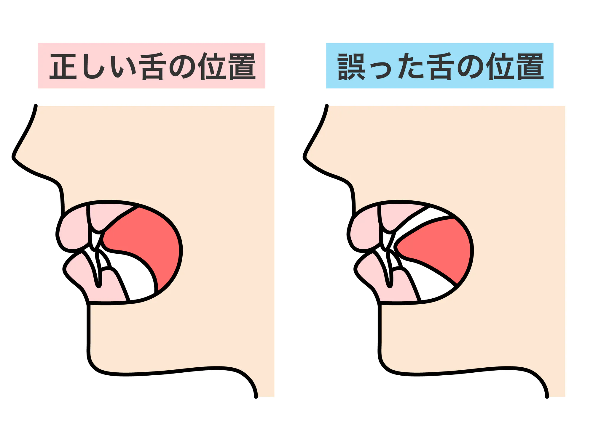 MFT（口腔筋機能療法）は川崎市の中野島にあるGOGO歯科クリニック｜口 